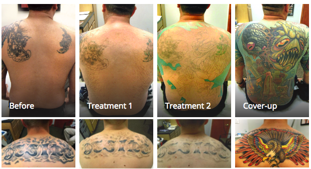 Laser Tattoo Removal  OM Laser  Wellness