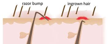 What Causes Razor Rashes and How to Prevent Bumps